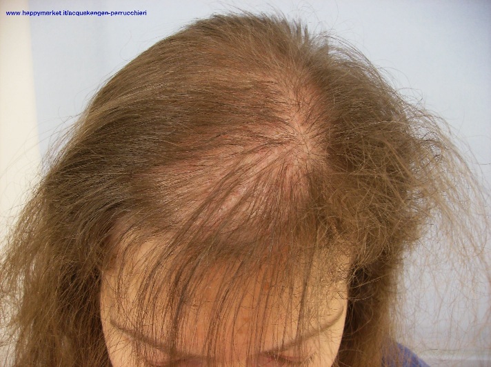 alopecia femminile 712x532